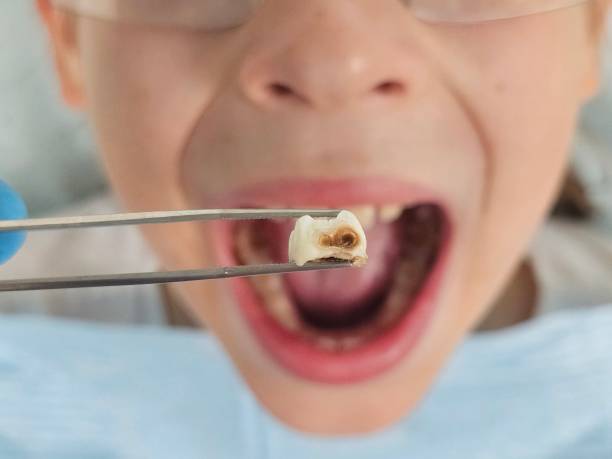 Best Emergency Root Canal Treatment in Bonnetsville, NC